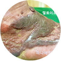 전층 이식 흉터