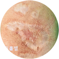 표재성 2도 화상 흉터