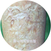 3도 화상 흉터